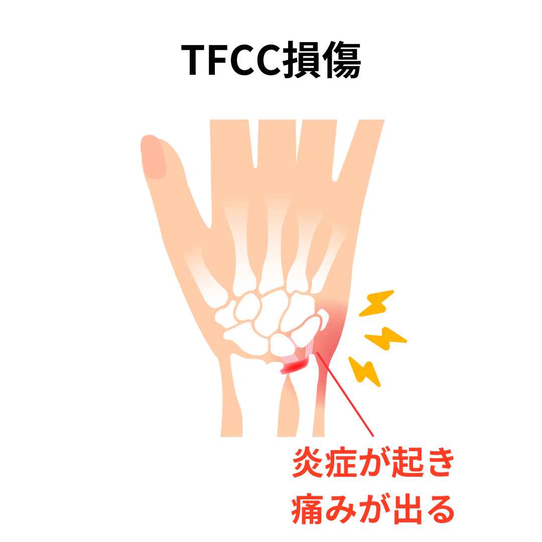 TFCC損傷