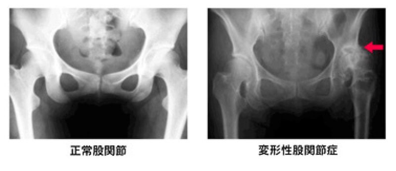 変形性股関節症