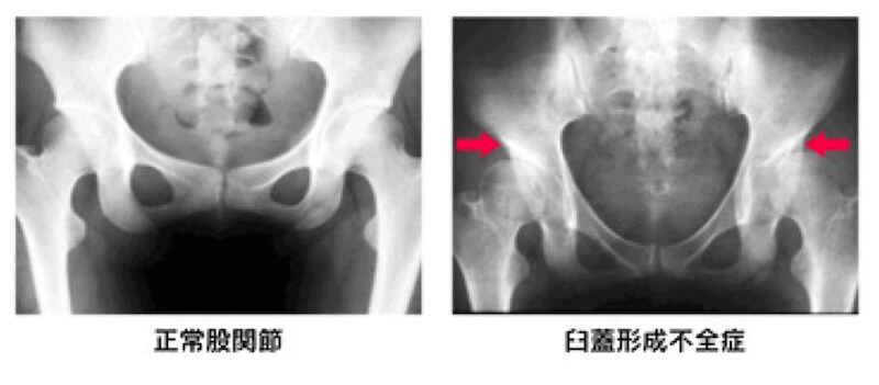 変形性股関節症