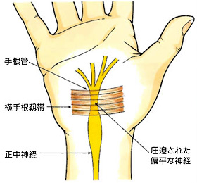 手根管症候群