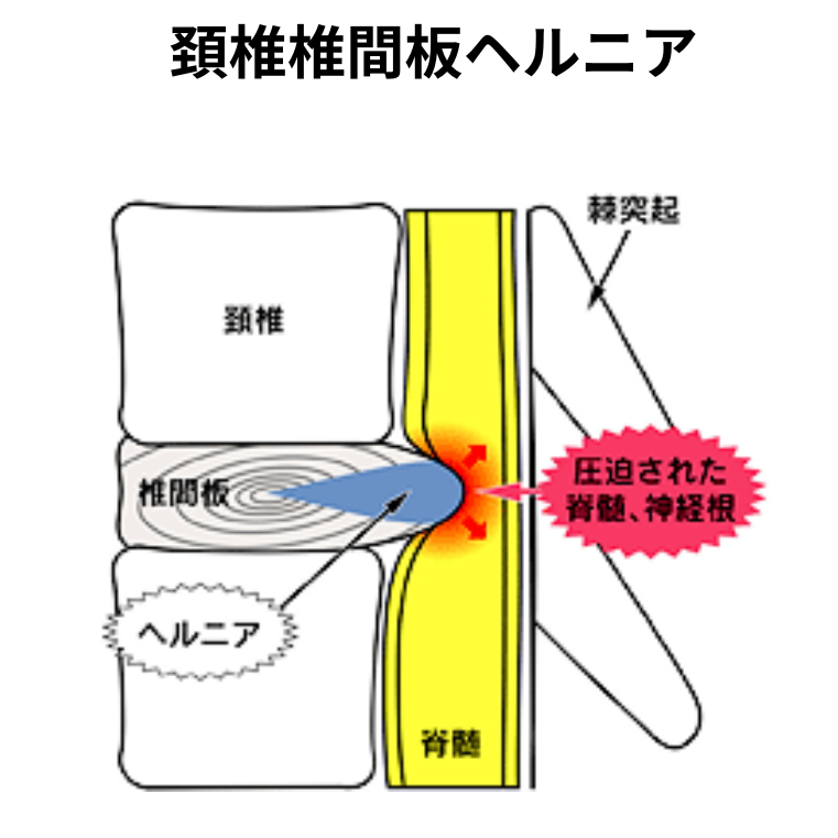 頚椎椎間板ヘルニア