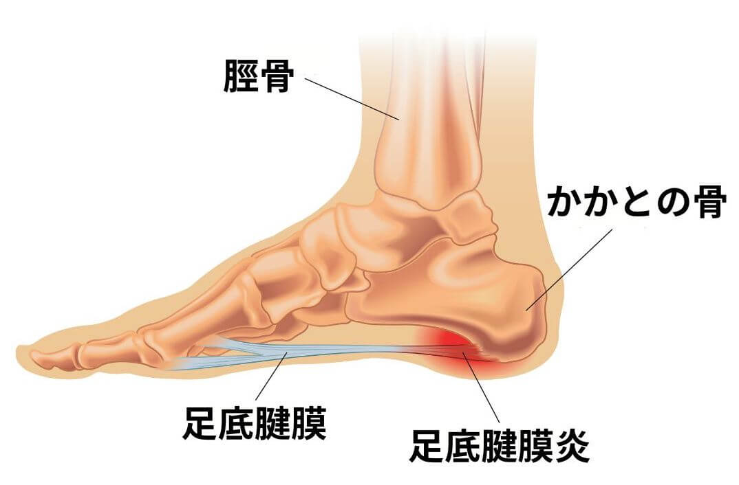 足底腱膜炎