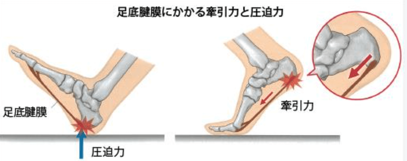 足底腱膜炎