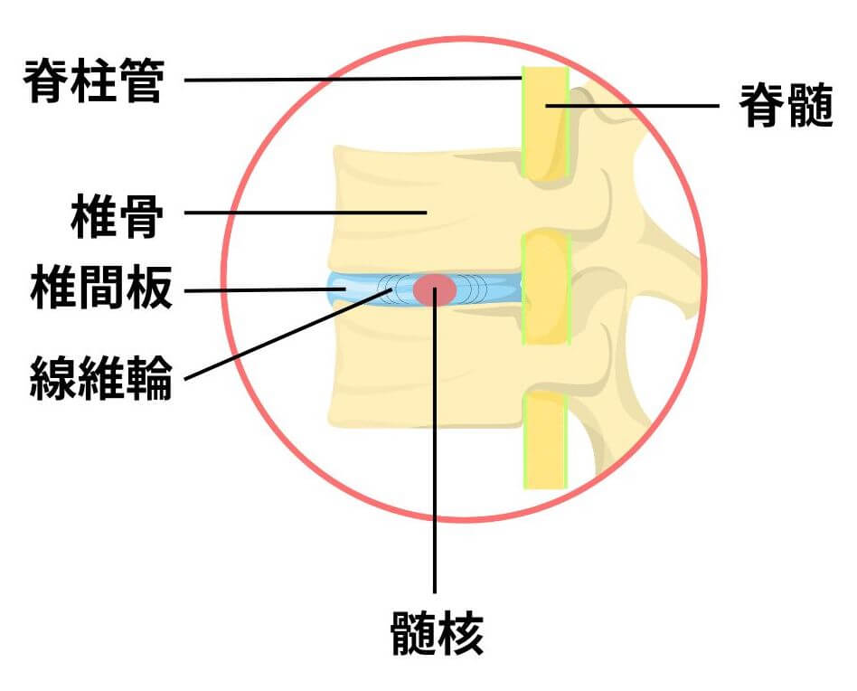 頚椎椎間板